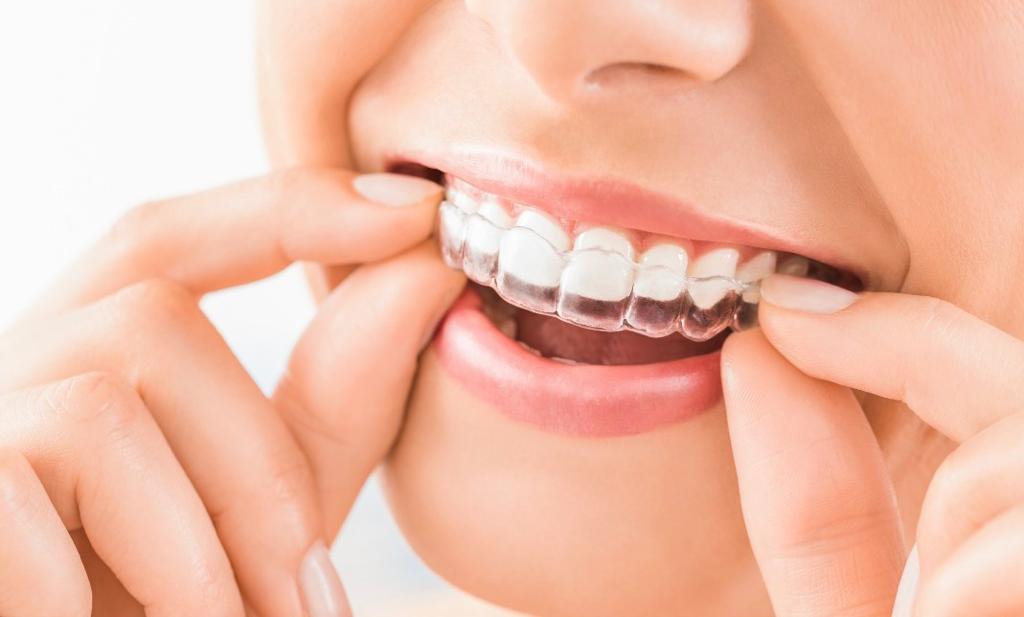 ortodoncia-invisible-invisalign-sjd-dentistas-tenerife