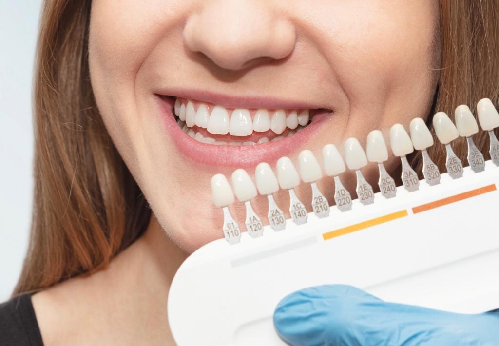 blanqueamiento-dental-tenerife-sjd-dentistas