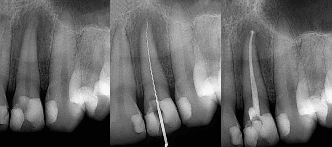 endodoncia-tenerife-sjd-dentistas