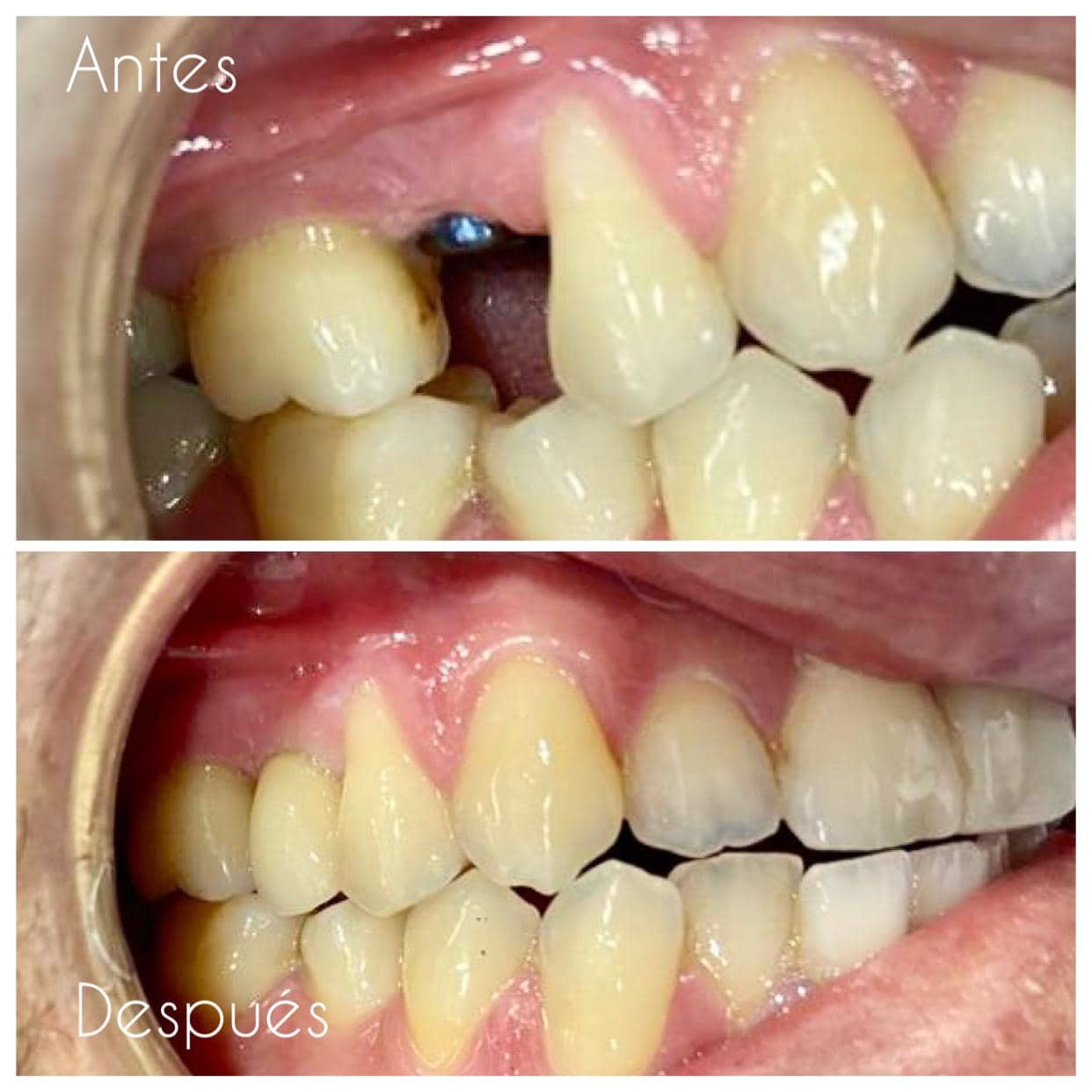 implantes-dentales-tenerife-sjd-dentistas-resultados