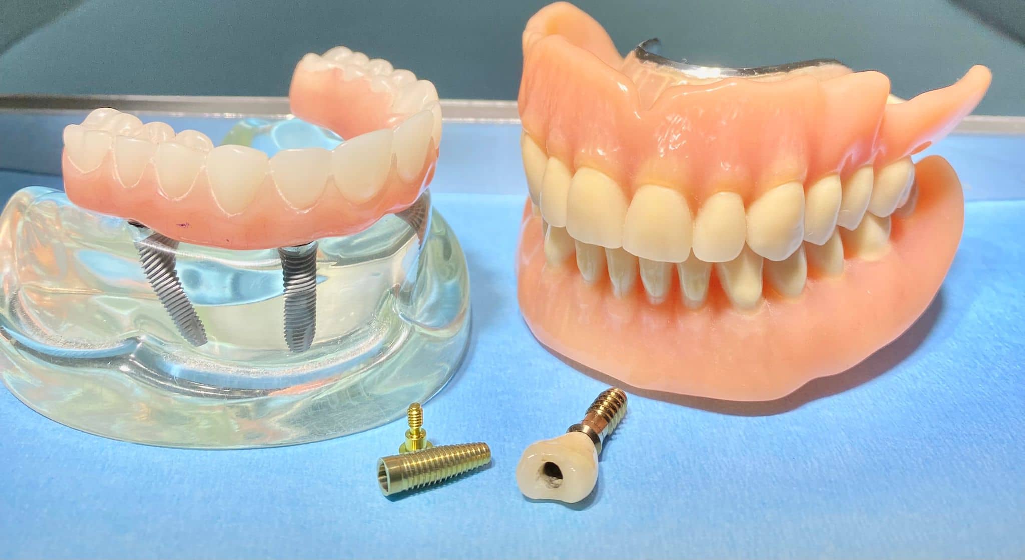 implantes-dentales-tenerife-sjd-dentistas