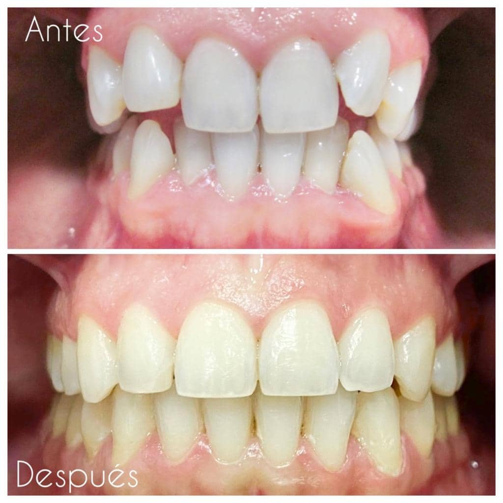 ortodoncia-invisible-invisalign-sjd-dentistas-banner