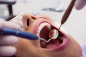 dentista en tenerife - espejo en boca