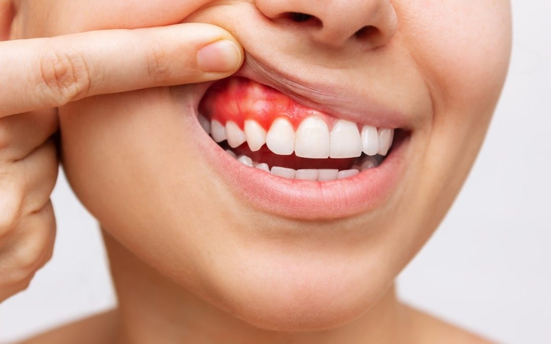 Gingivitis: Causas, síntomas, tratamientos y prevención