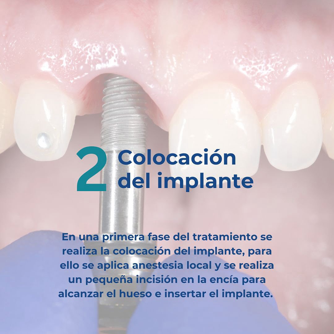 fase-2-colocacion-implante-dental