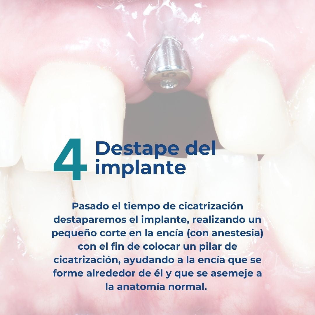 fase 4 destape del implante dental<br />
