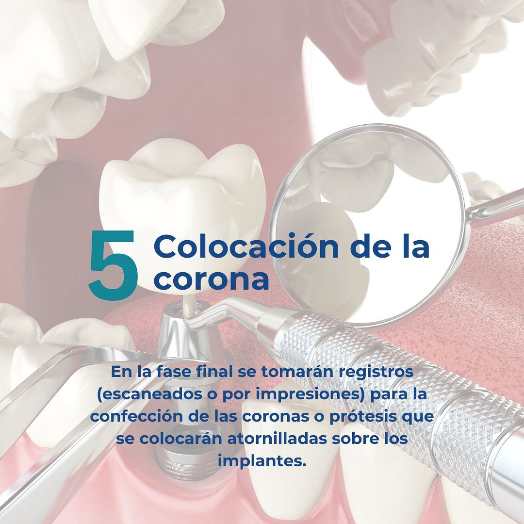 fase 5 colocación del implante dental