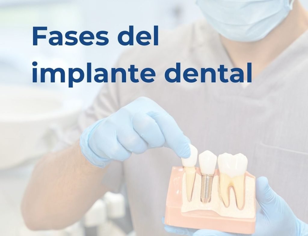 Las-fases-del-implante-dental