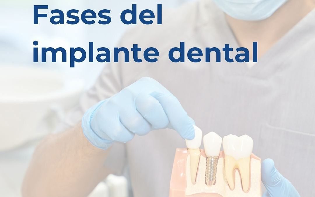 Phases of a dental implant