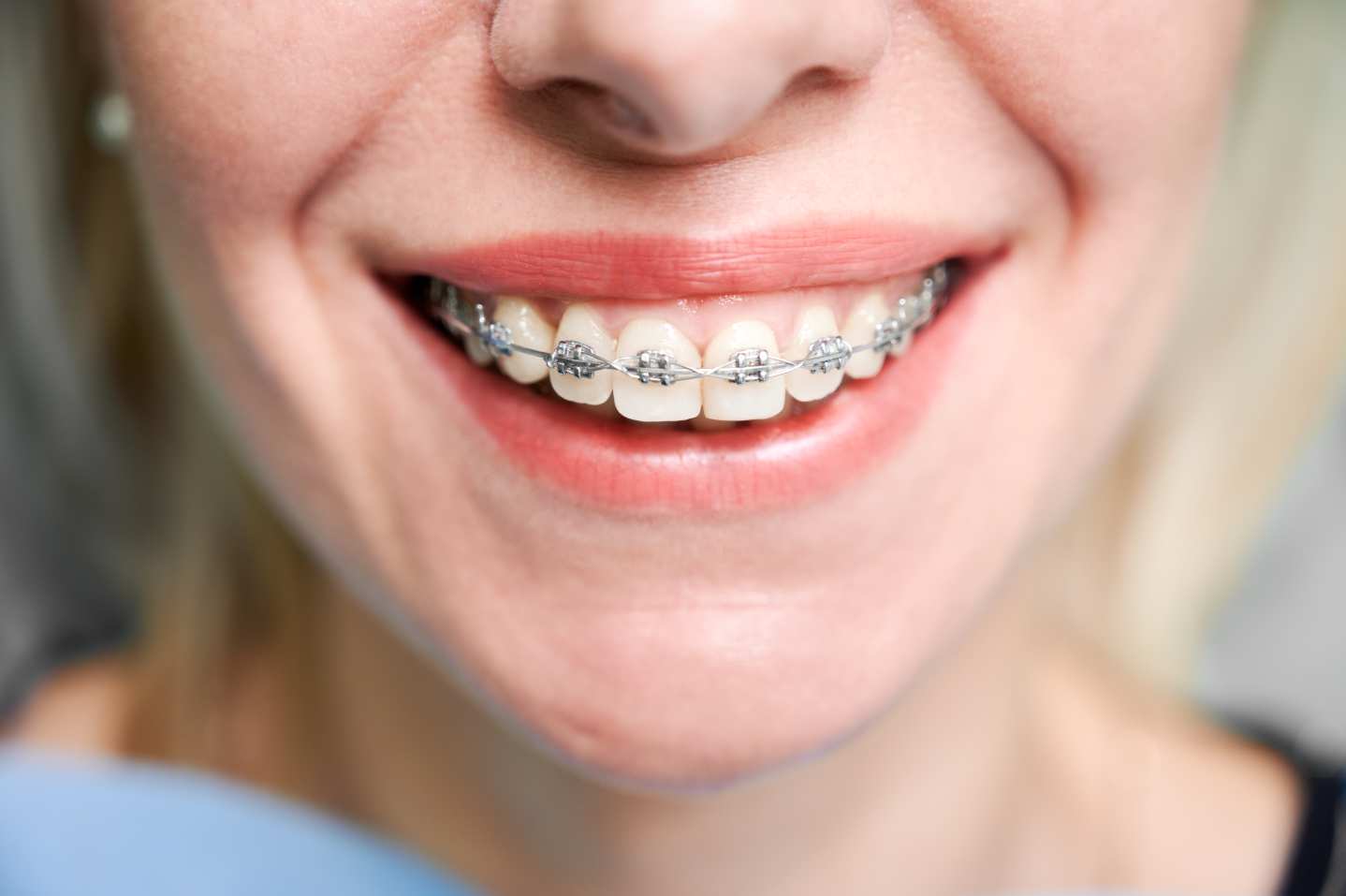 dental clinic in tenerife - brackets