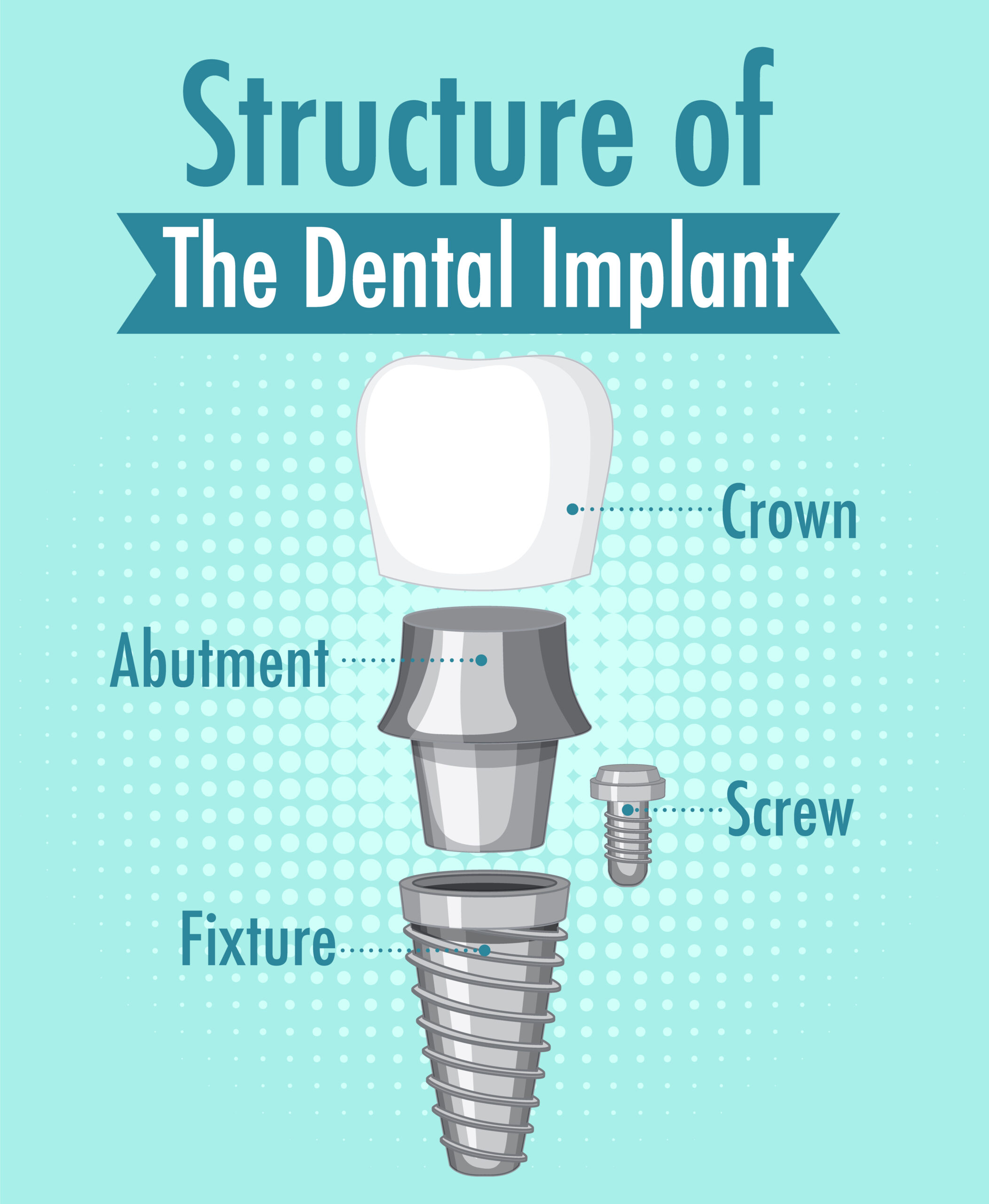 dental implantology in tenerife - structure